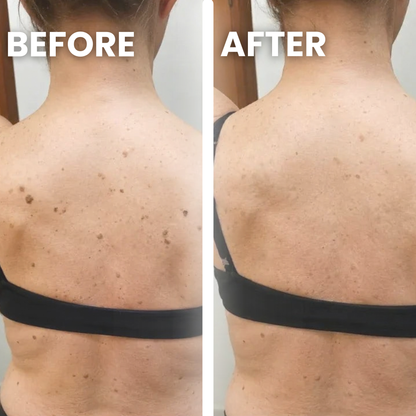 Seborrheic Keratoses Glycolic Body Stick