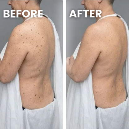 Seborrheic Keratoses Glycolic Body Stick