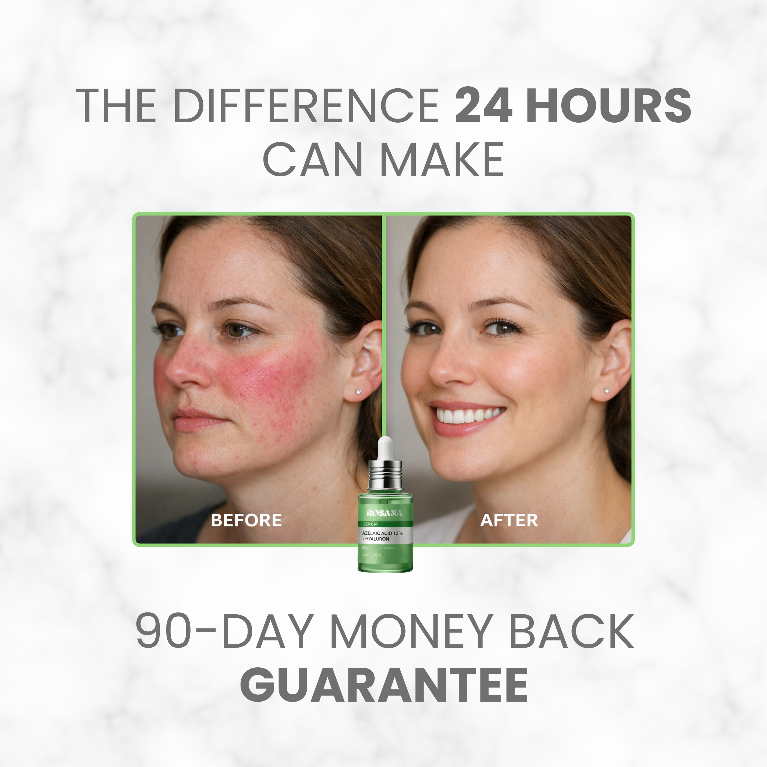 Rosacea Azelaic Acid Treatment