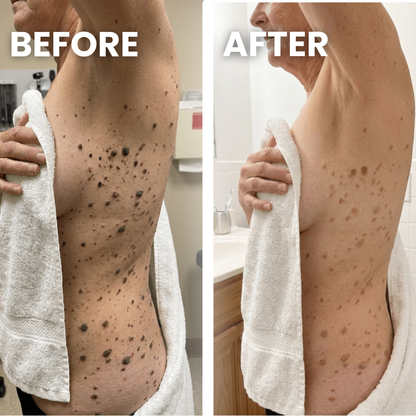 Seborrheic Keratoses Glycolic Body Stick