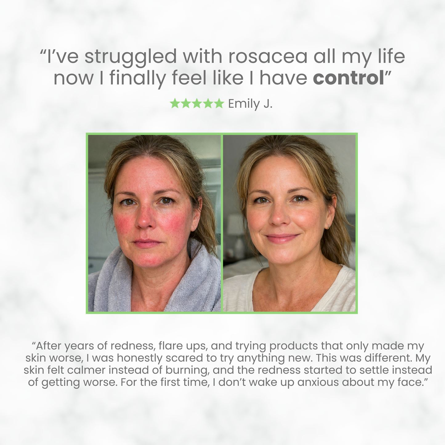 Rosacea Azelaic Acid Treatment