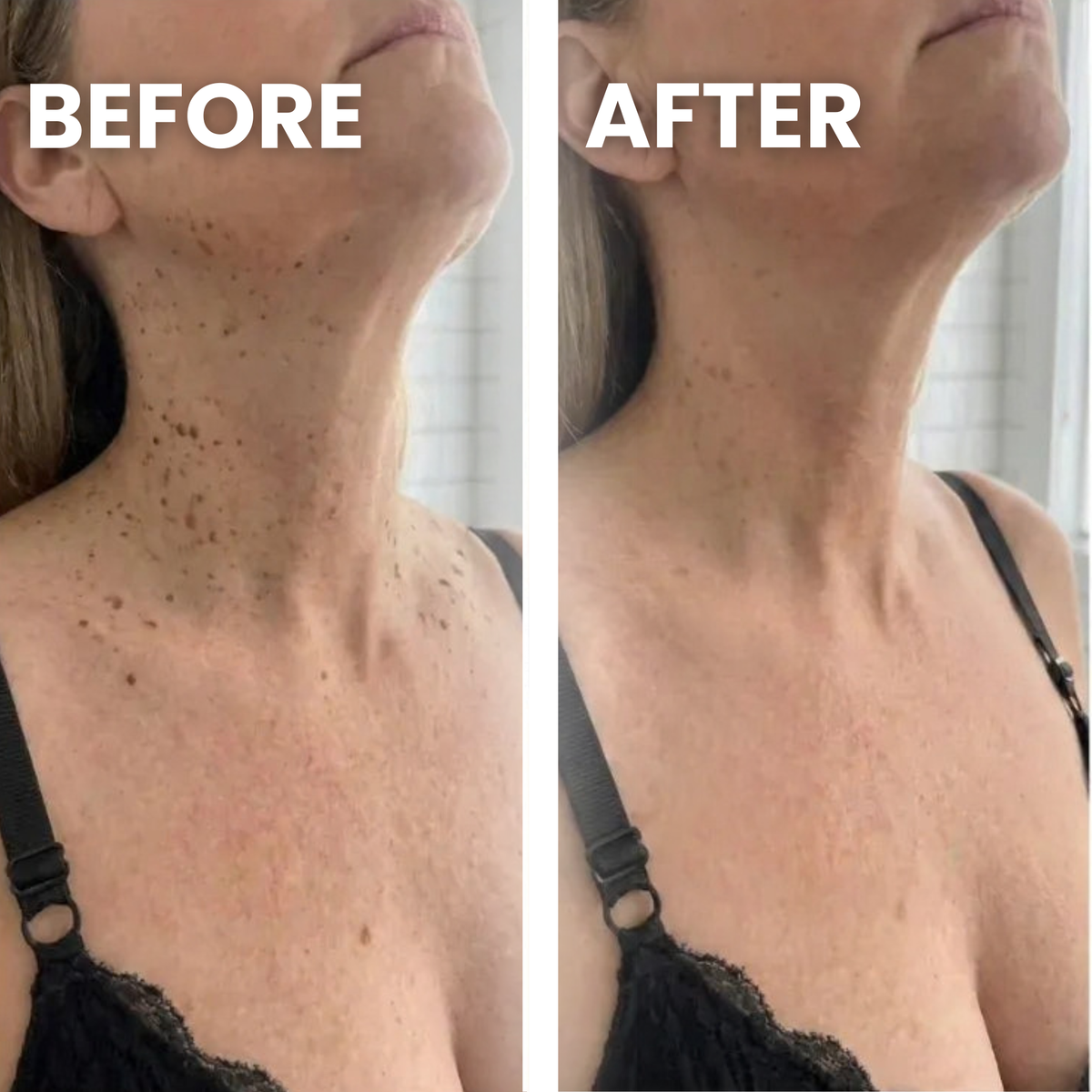 Seborrheic Keratoses Glycolic Body Stick